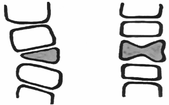 Abb. 1: Einfacher Keilwirbel mit Verkrümmung der Wirbelsäule (links). Doppelter „Butterfly vertebra“ (rechts).